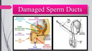 Damaged Sperm Ducts
 