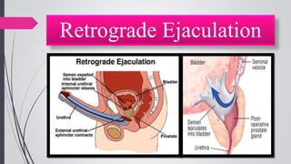Retrograde Ejaculation
 