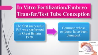 In Vitro Fertilization/Embryo
Transfer/Test Tube Conception
The first successful
IVF was performed
in Great Britain
1978.
Common whose
oviducts have been
damaged.
 