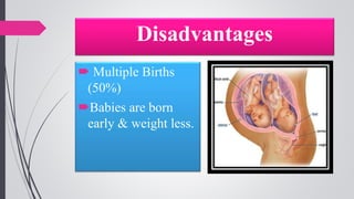 Disadvantages
 Multiple Births
(50%)
Babies are born
early & weight less.
 