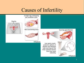 5
Causes of Infertility
 