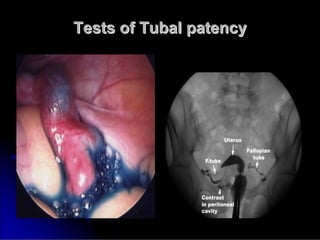 Tests of Tubal patency
Tests of Tubal patency
 
