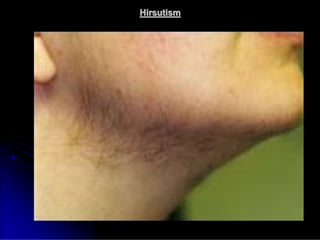 Hirsutism
Hirsutism
 