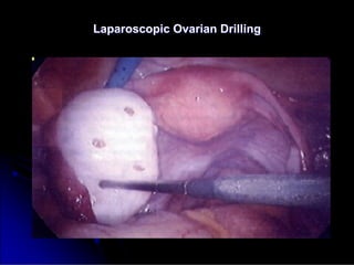 Laparoscopic Ovarian Drilling
Laparoscopic Ovarian Drilling
 