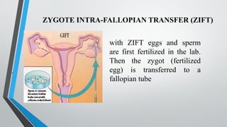 ZYGOTE INTRA-FALLOPIAN TRANSFER (ZIFT)
.
with ZIFT eggs and sperm
are first fertilized in the lab.
Then the zygot (fertilized
egg) is transferred to a
fallopian tube
 