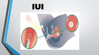 IUI
 