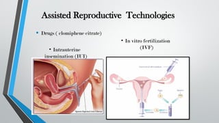 Assisted Reproductive Technologies
• Drugs ( clomiphene citrate)
• In vitro fertilization
(IVF)
• Intrauterine
insemination (IUI)
 