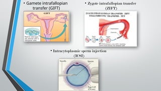 • Gamete intrafallopian
transfer (GIFT)
• Zygote intrafallopian transfer
(ZIFT)
• Intracytoplasmic sperm injection
(ICSI)
 