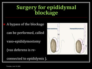 Surgery for epididymal
blockage
 A bypass of the blockage
can be performed, called
vaso-epididymostomy
(vas deferens is re-
connected to epididymis ).
Thursday, June 18, 2020
 