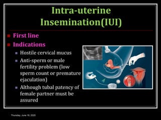 Intra-uterine
Insemination(IUI)
 First line
 Indications
 Hostile cervical mucus
 Anti-sperm or male
fertility problem (low
sperm count or premature
ejaculation)
 Although tubal patency of
female partner must be
assured
Thursday, June 18, 2020
 