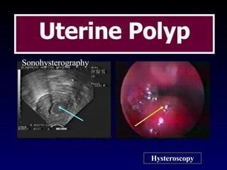 36 38 Uterine Polyp Sonohysterography Hysteroscopy 