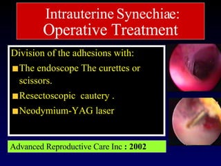 Division of the adhesions with: The endoscope The curettes or scissors.  Resectoscopic  cautery . Neodymium-YAG laser  Advanced Reproductive Care Inc  : 2002 121 Intrauterine Synechiae:   Operative Treatment 
