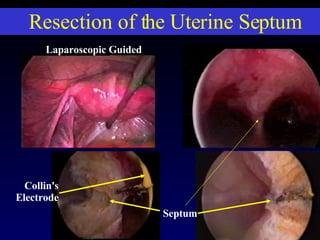 Resection of the Uterine Septum 121 Laparoscopic Guided Septum Collin's Electrode 