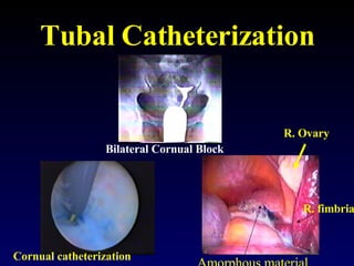 Tubal Catheterization Bilateral Cornual Block Amorphous material R. Ovary R. fimbria Cornual catheterization 