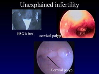 ` Unexplained infertility Cornual polyp cervical polyp HSG is free 