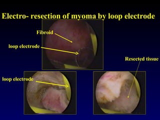 Electro- resection of myoma by loop electrode loop electrode loop electrode Fibroid Resected tissue 