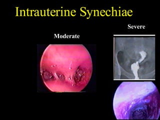 Intrauterine Synechiae Severe Moderate 