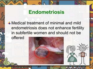 Endometriosis 
Medical treatment of minimal and mild 
endometriosis does not enhance fertility 
in subfertile women and should not be 
offered 
 