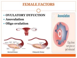 FEMALE FACTORS
 OVULATORY DYFUCTION
 Anovulation
 Oligo ovulation
 