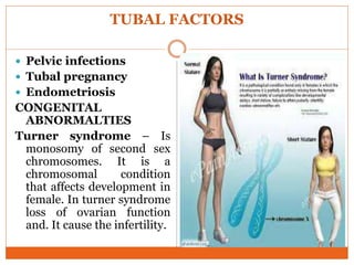 TUBAL FACTORS
 Pelvic infections
 Tubal pregnancy
 Endometriosis
CONGENITAL
ABNORMALTIES
Turner syndrome – Is
monosomy of second sex
chromosomes. It is a
chromosomal condition
that affects development in
female. In turner syndrome
loss of ovarian function
and. It cause the infertility.
 