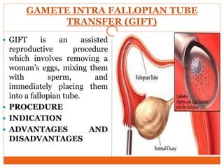 GAMETE INTRA FALLOPIAN TUBE
TRANSFER (GIFT)
 GIFT is an assisted
reproductive procedure
which involves removing a
woman’s eggs, mixing them
with sperm, and
immediately placing them
into a fallopian tube.
 PROCEDURE
 INDICATION
 ADVANTAGES AND
DISADVANTAGES
 