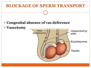 BLOCKAGE OF SPERM TRANSPORT
 Congenital absence of vas deference
 Vasectomy
 