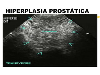 HIPERPLASIA PROSTÁTICA
 