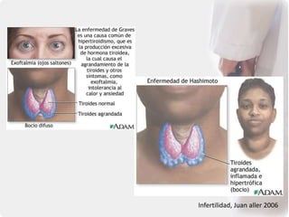 Infertilidad, Juan aller 2006
 
