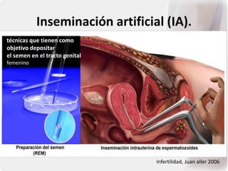 Inseminación artificial (IA).
Infertilidad, Juan aller 2006
técnicas que tienen como
objetivo depositar
el semen en el tracto genital
femenino
 