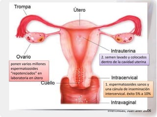 Infertilidad, Juan aller 2006
1. espermatozoides sanos y
una cánula de inseminación
intercervical. éxito 5% a 10%
2. semen lavado y colocados
dentro de la cavidad uterina
ponen varios millones
espermatozoides
“repotenciados” en
laboratoria en útero
 