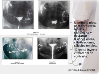 • la primera placa,
para verificar la
técnica
radiológica y
descartar
lesiones óseas,
calcificaciones,
cálculos renales,
• luego se inyecta
el material de
contraste.
Infertilidad, Juan aller 2006
 