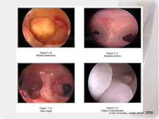 Infertilidad, Juan aller 2006
 