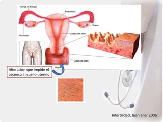 Infertilidad, Juan aller 2006
Alteracion que impide el
ascenso al cuello uterino
 