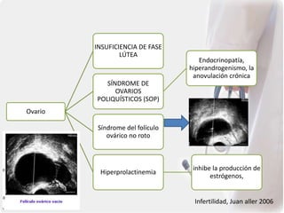 Ovario
INSUFICIENCIA DE FASE
LÚTEA
SÍNDROME DE
OVARIOS
POLIQUÍSTICOS (SOP)
Endocrinopatía,
hiperandrogenismo, la
anovulación crónica
Síndrome del folículo
ovárico no roto
Hiperprolactinemia
inhibe la producción de
estrógenos,
Infertilidad, Juan aller 2006
 