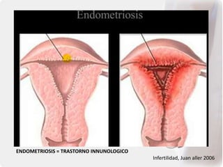 Infertilidad, Juan aller 2006
ENDOMETRIOSIS = TRASTORNO INNUNOLOGICO
 