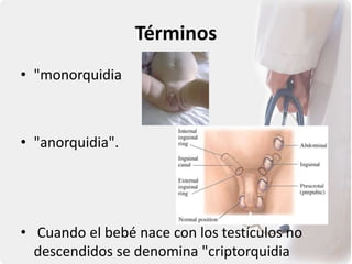Términos
• "monorquidia
• "anorquidia".
• Cuando el bebé nace con los testículos no
descendidos se denomina "criptorquidia
 