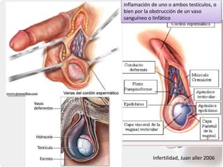 Infertilidad, Juan aller 2006
Varicocele: aumenta
la temp.
inflamación de uno o ambos testículos, o
bien por la obstrucción de un vaso
sanguíneo o linfático
 