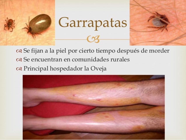 El limón con el ajo a la psoriasis