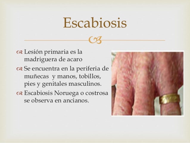Quien curaba atopichesky la dermatitis al niño
