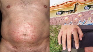 Parasite Rashes In Humans Parasitic infestation of the skin in dermatology | PPTX