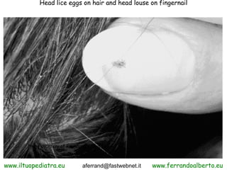 Head lice eggs on hair and head louse on fingernail




       Photo courtesy of Foundation Studios



www.iltuopediatra.eu            aferrand@fastwebnet.it   www.ferrandoalberto.eu
 