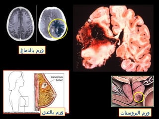 ‫بالدماغ‬ ‫ورم‬
‫بالثدي‬ ‫ورم‬ ‫البروستات‬ ‫ورم‬
 
