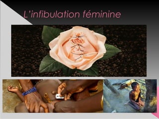 L’infibulation féminine
 