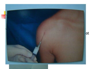 Tendinitis bicipital Aguja verde Jeringa 2cc - 5cc 1 cc corticoide depot 1 cc anestésico 