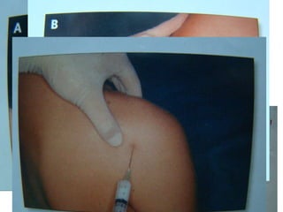 Art. glenohumeral Aguja verde Jeringa 2cc - 5cc 1-2 cc cort. depot 1 cc anestésico 