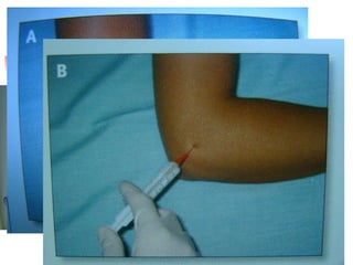 Epicondilitis Aguja naranja Jeringa 2cc - 5cc 0.5 cc cort. depot 0.5 cc anestésico 