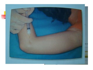 Epitrocleitis Aguja naranja Jeringa 2cc - 5cc 0.5-1 cc cort. depot 0.5 cc anestésico 