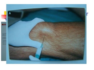 Art. femorotibial y femoropatelar Aguja verde Jeringa 5cc 2 cc cort. depot 2 cc anestésico 