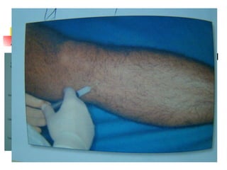 Pata de ganso o bursitis anserina Aguja naranja o azul Jeringa 2cc  1 cc cort. depot 1 cc anestésico 