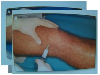 Bursitis subcuadricipital y prerrotuliana Aguja verde Jeringa 10 cc - 5cc 2 cc cort. depot 2 cc anestésico (opcional) Aguja azul Jeringa 2 cc  1 cc cort. depot 1 cc anestésico  
